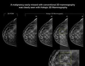 3D Mammography 3D Mammography